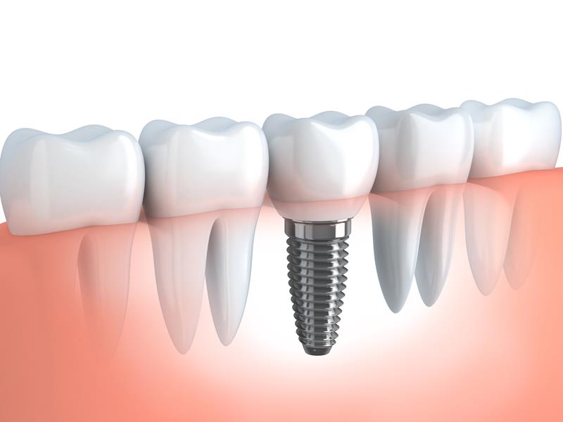 Dental Implants  Norco, CA 